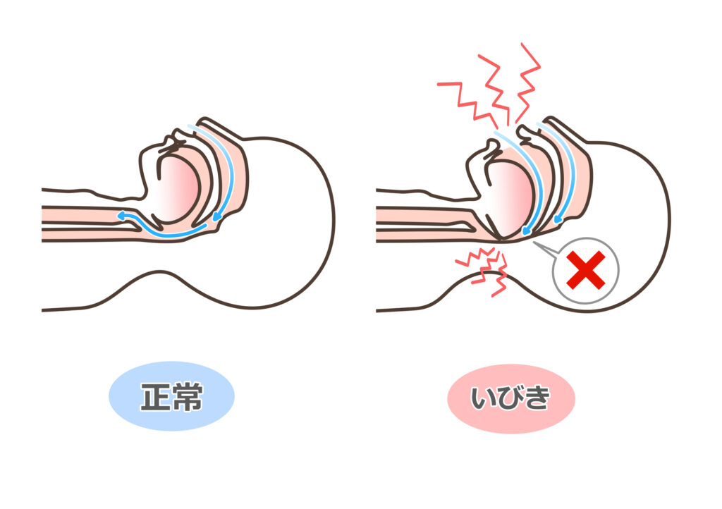 うるさいだけじゃない、いびきの話